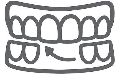 Overbite